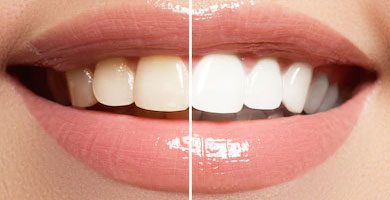 Blanqueamiento dental